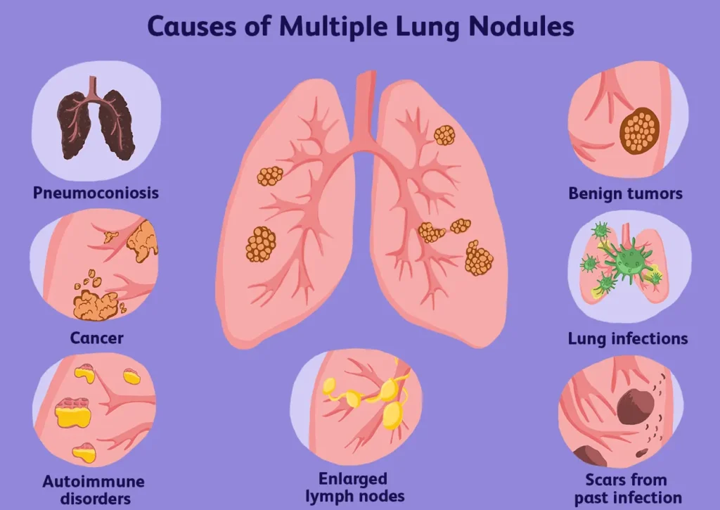 Can I get rid of my pulmonary nodules if I find out about them and regulate them with herbs?