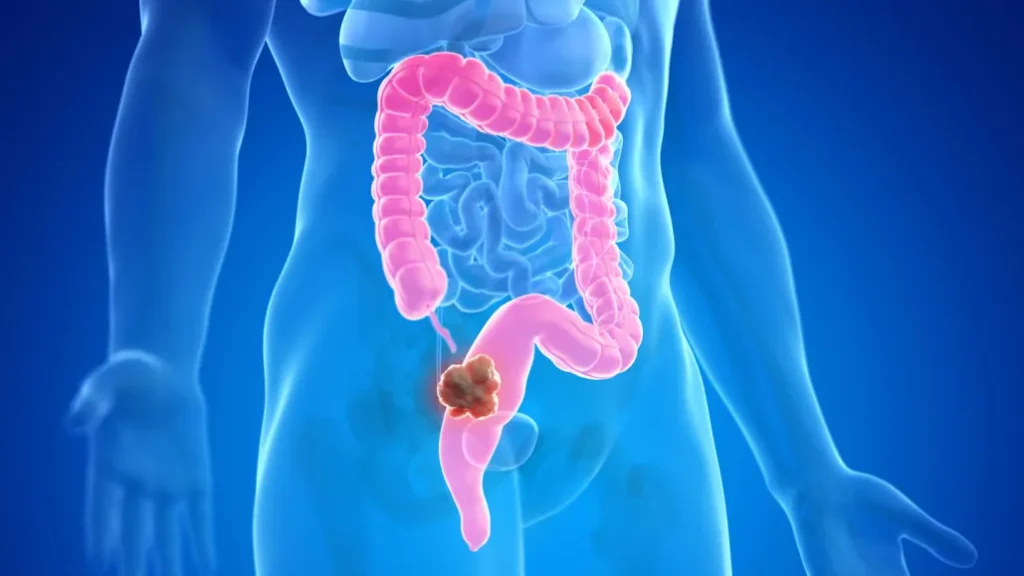Detecting Colorectal Cancer: Pay Attention to Abnormal Signs During Bowel Movements
