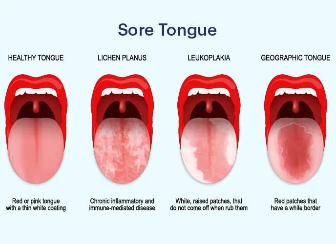 What Causes Thick Yellow Coating on the Tongue Traditional Chinese